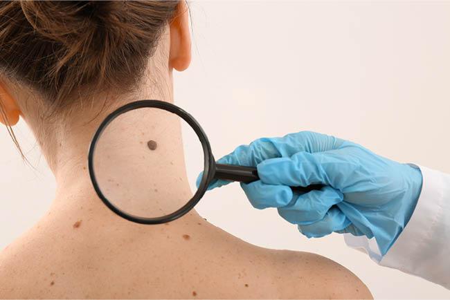 Dermatology - A doctor looking at a mole with a magnifying glass